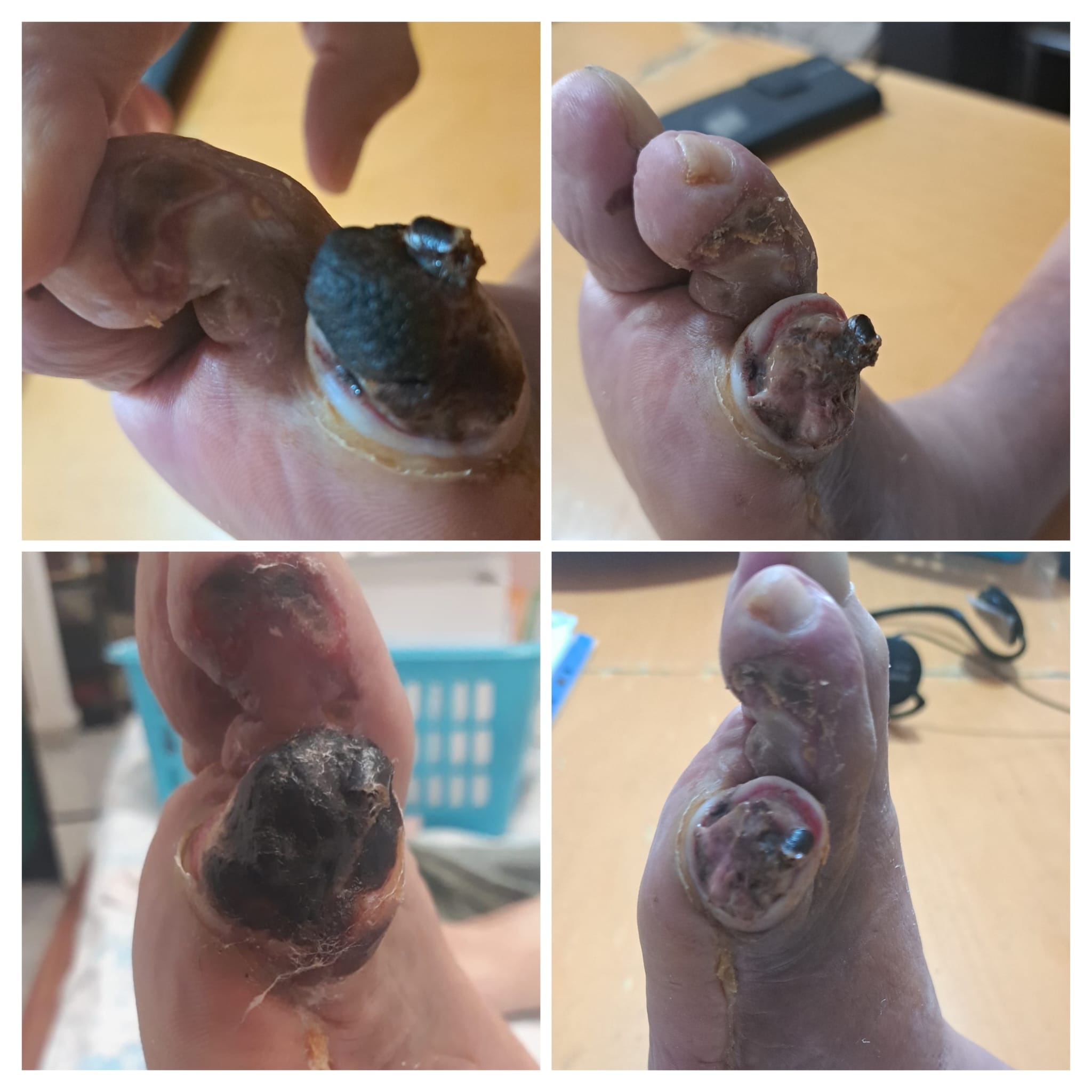 מקרה קליני: נמק אצבע לפני ואחרי